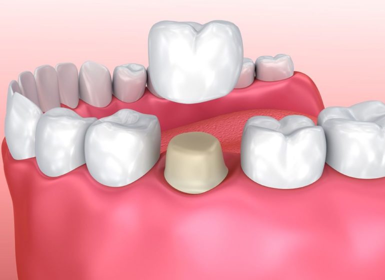 Coronas-dentales (1)