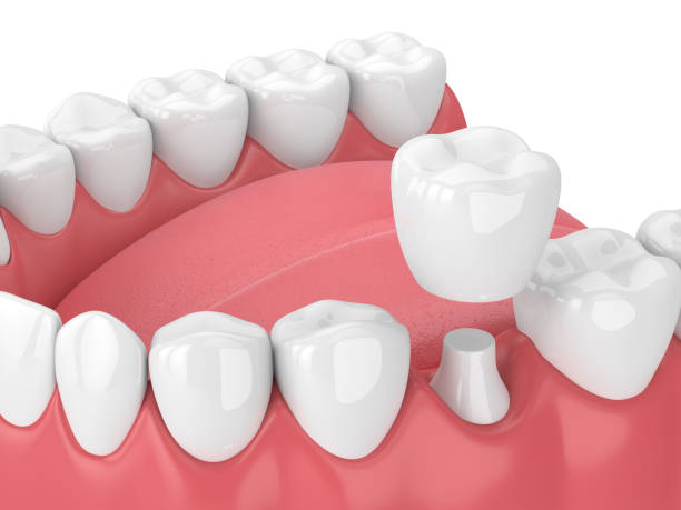 3d render of jaw with teeth and dental crown restoration over white background