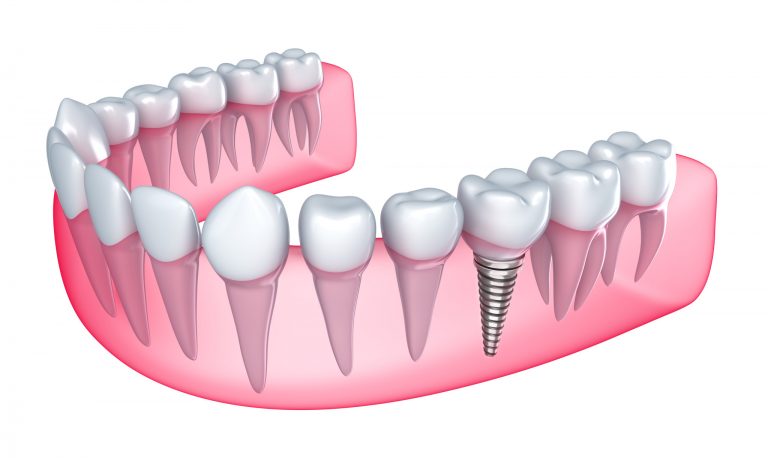 Implantes-dentales-6-768x458