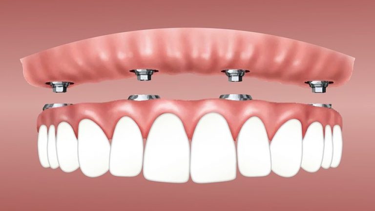 Implantes-dentales-768x432